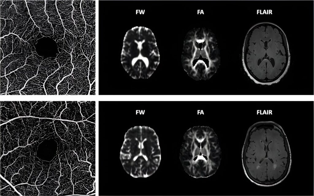 Study discovers possible tool to diagnose common contributor to vascular dementia