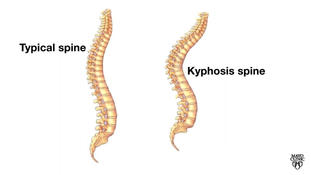 Mayo Clinic Minute: Help with kyphosis, or roundback