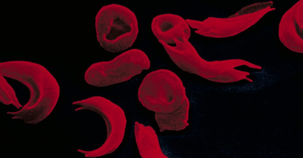 Sickle-Cell Treatment Created With Gene Editing Wins U.K. Approval